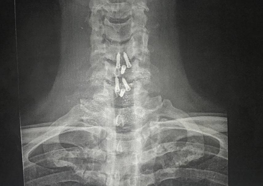 Рентгеновский снимок пострадавшего участка позвоночника Ноя Хэтэуэя.